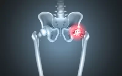 Focus on the Hip Part 2 – Osteoarthritis