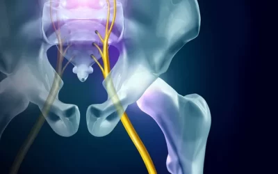 Focus on Sciatica